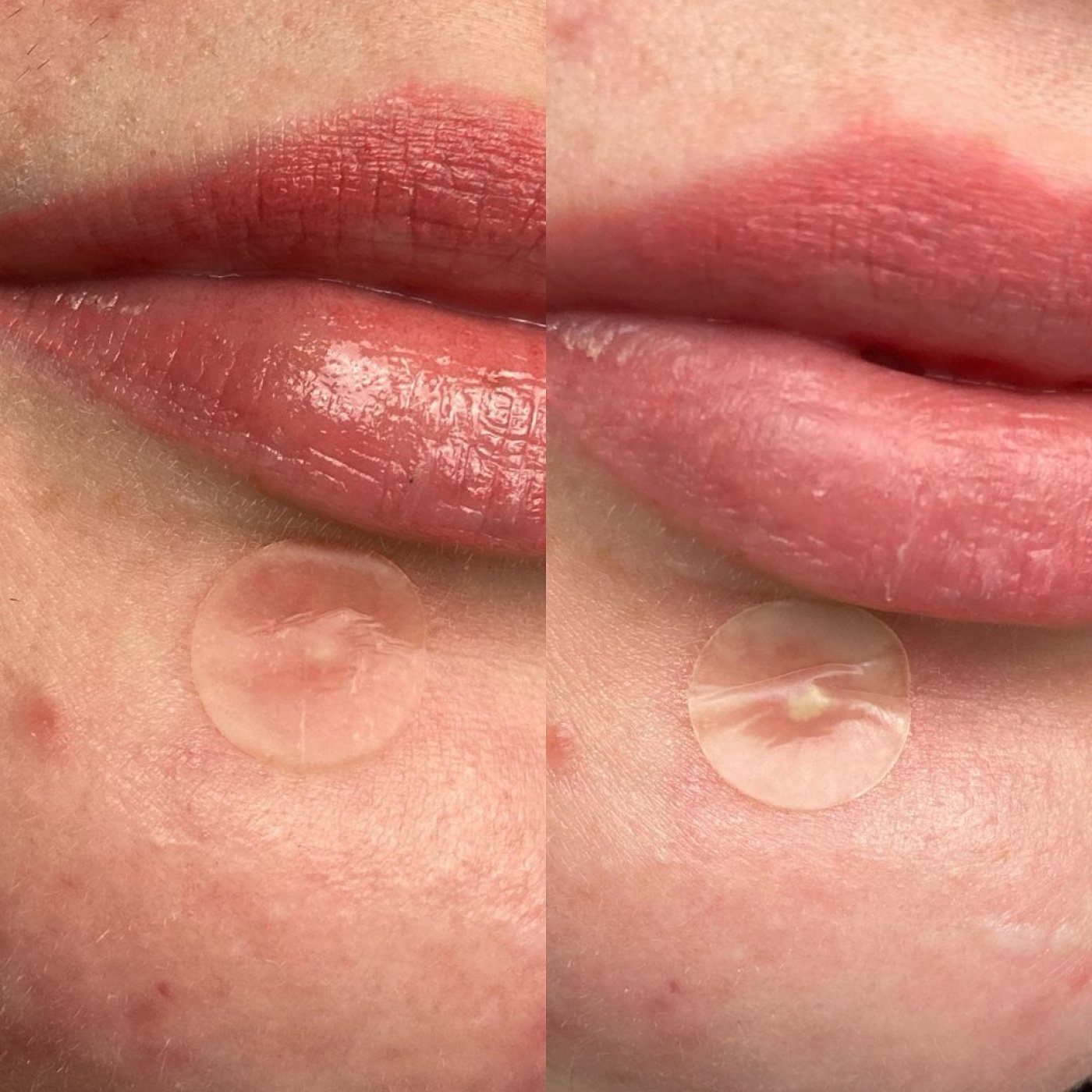 Close-up of lips with a Hero Cosmetics Mighty Patch® on the skin below. The image splits: left shows the patch pre-use, right shows visible changes in the blemish after using Heros effective Mighty Patch® The Original - 36 Patches.